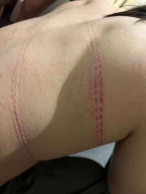 SUMERAGI(スメラギ) 縄痕