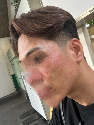 GAKU(ｶﾞｸ) 全顔治療